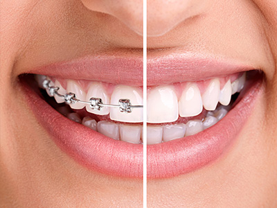 5th Avenue Dentistry and Implants P.L.L.C. | ZOOM  Whitening, Night Guards and Oral Exams