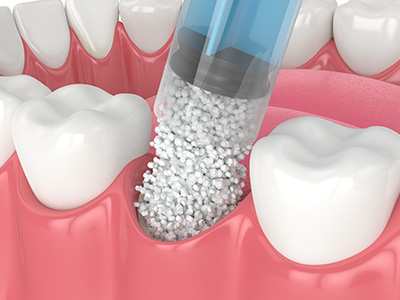 5th Avenue Dentistry and Implants P.L.L.C. | Fluoride Treatment, Dentures and Snoring Appliances