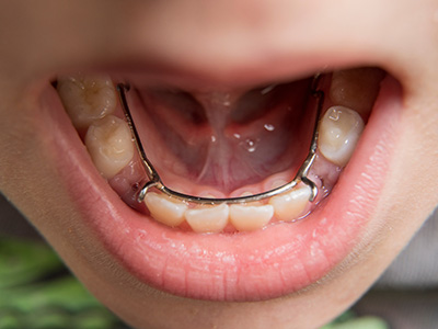 5th Avenue Dentistry and Implants P.L.L.C. | CBCT, ZOOM  Whitening and Dental Fillings