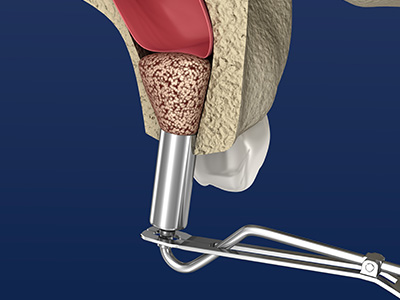 5th Avenue Dentistry and Implants P.L.L.C. | ZOOM  Whitening, Implant Restorations and Veneers