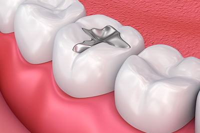 5th Avenue Dentistry and Implants P.L.L.C. | Oral Cancer Screening, Implant Dentistry and Implant Restorations