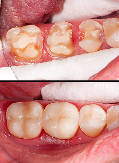 5th Avenue Dentistry and Implants P.L.L.C. | Dental Bridges, LANAP reg  and Fluoride Treatment