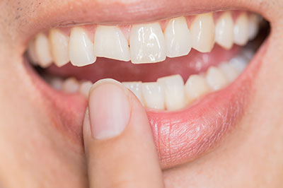 5th Avenue Dentistry and Implants P.L.L.C. | Dental Fillings, ZOOM  Whitening and Dental Sealants