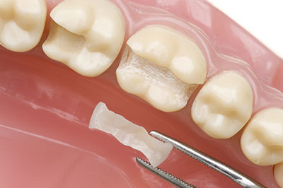 5th Avenue Dentistry and Implants P.L.L.C. | Root Canals, Oral Exams and ZOOM  Whitening