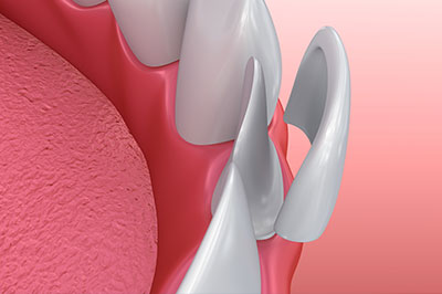 5th Avenue Dentistry and Implants P.L.L.C. | Extractions, Teeth Whitening and ZOOM  Whitening