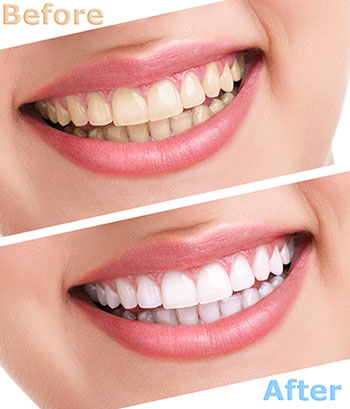 5th Avenue Dentistry and Implants P.L.L.C. | Fluoride Treatment, Emergency Treatment and ZOOM  Whitening