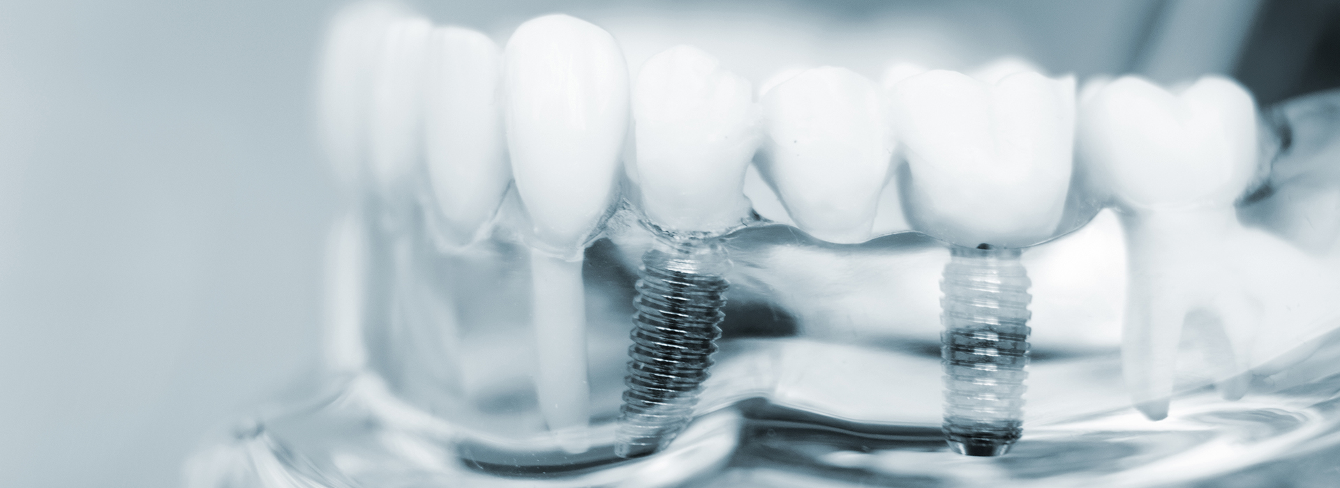 5th Avenue Dentistry and Implants P.L.L.C. | Sleep Apnea, Digital Radiography and Night Guards
